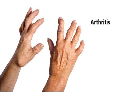 Arthritis Treatment